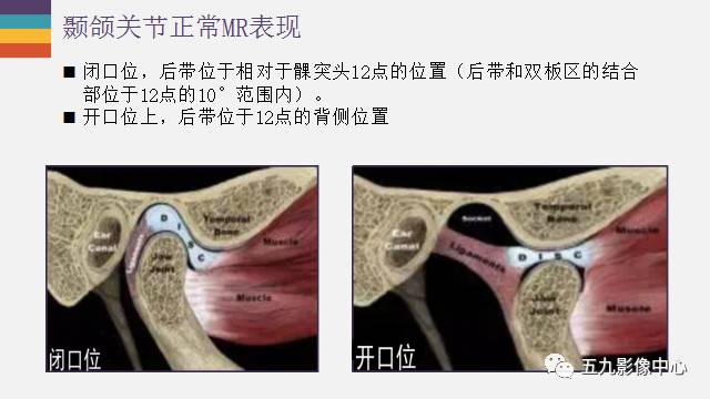 【PPT】颞颌关节病变的MR诊断