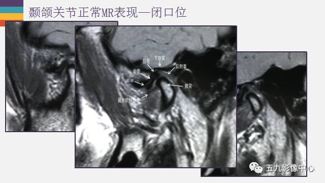 【PPT】颞颌关节病变的MR诊断