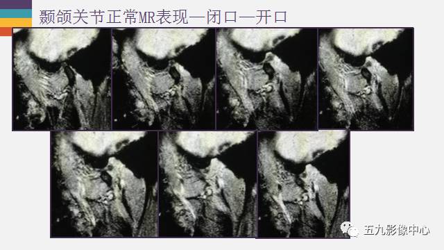 【PPT】颞颌关节病变的MR诊断