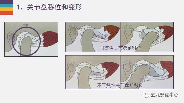 【PPT】颞颌关节病变的MR诊断