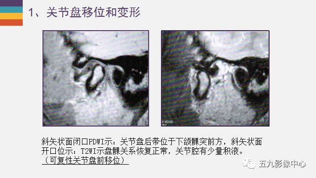 【PPT】颞颌关节病变的MR诊断