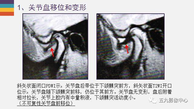 【PPT】颞颌关节病变的MR诊断
