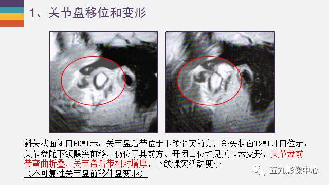 【PPT】颞颌关节病变的MR诊断