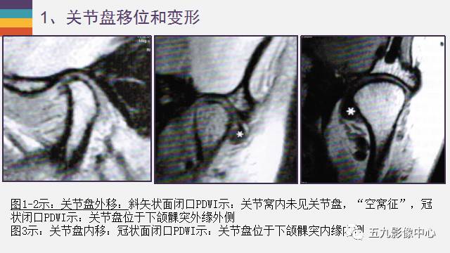 【PPT】颞颌关节病变的MR诊断