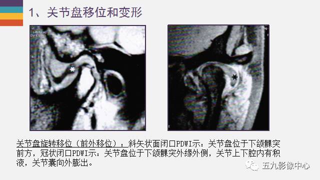 【PPT】颞颌关节病变的MR诊断