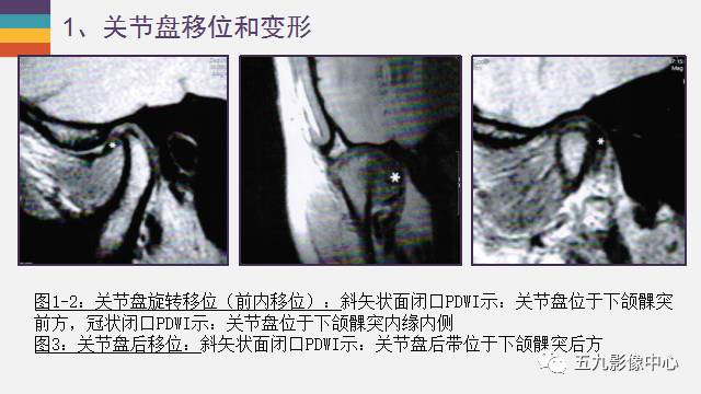 【PPT】颞颌关节病变的MR诊断
