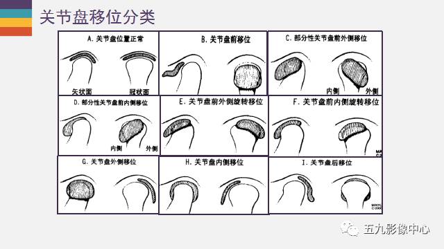 【PPT】颞颌关节病变的MR诊断