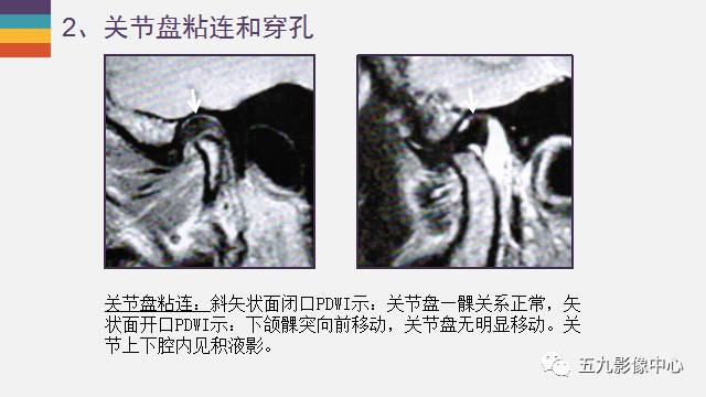 【PPT】颞颌关节病变的MR诊断