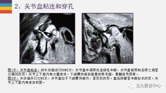 【PPT】颞颌关节病变的MR诊断