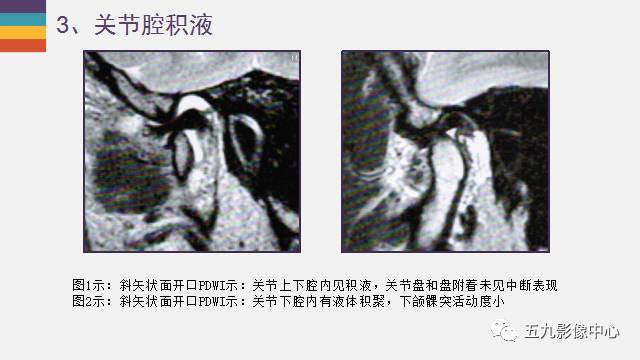 【PPT】颞颌关节病变的MR诊断