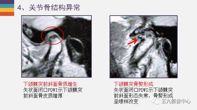 【PPT】颞颌关节病变的MR诊断