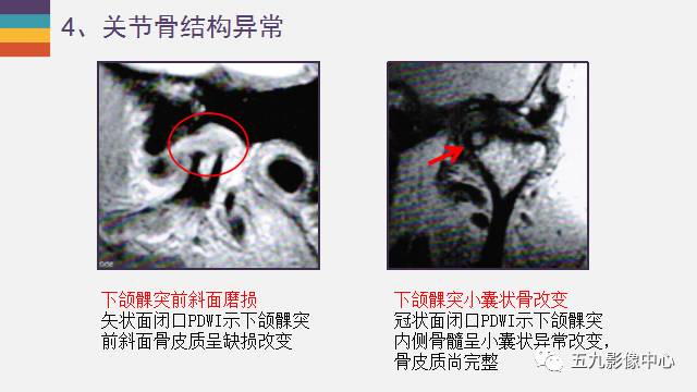 【PPT】颞颌关节病变的MR诊断