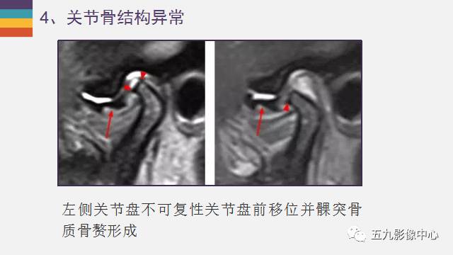 【PPT】颞颌关节病变的MR诊断