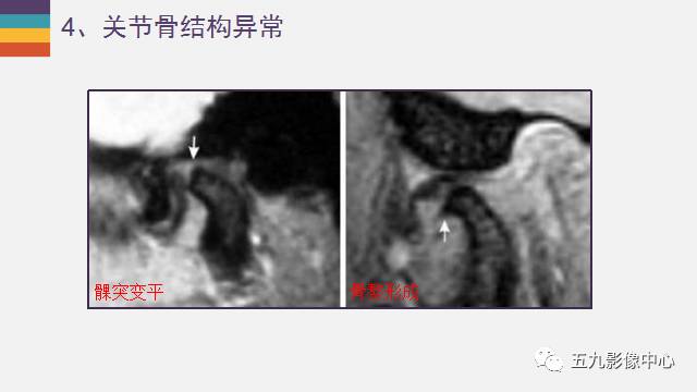 【PPT】颞颌关节病变的MR诊断