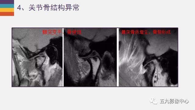【PPT】颞颌关节病变的MR诊断