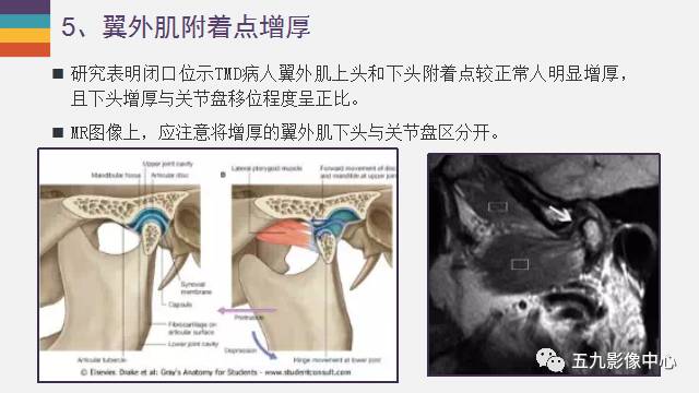 【PPT】颞颌关节病变的MR诊断