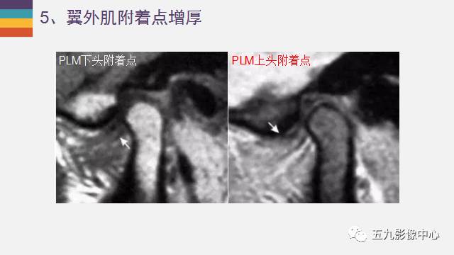 【PPT】颞颌关节病变的MR诊断