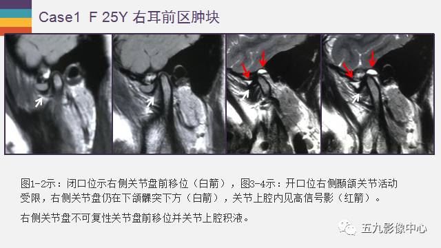 【PPT】颞颌关节病变的MR诊断