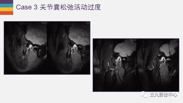 【PPT】颞颌关节病变的MR诊断