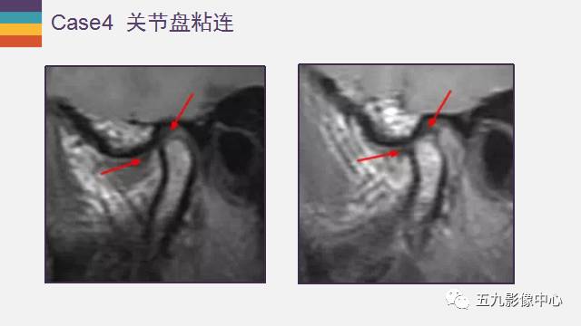 【PPT】颞颌关节病变的MR诊断