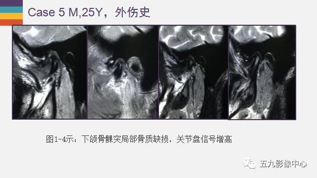 【PPT】颞颌关节病变的MR诊断
