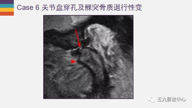 【PPT】颞颌关节病变的MR诊断