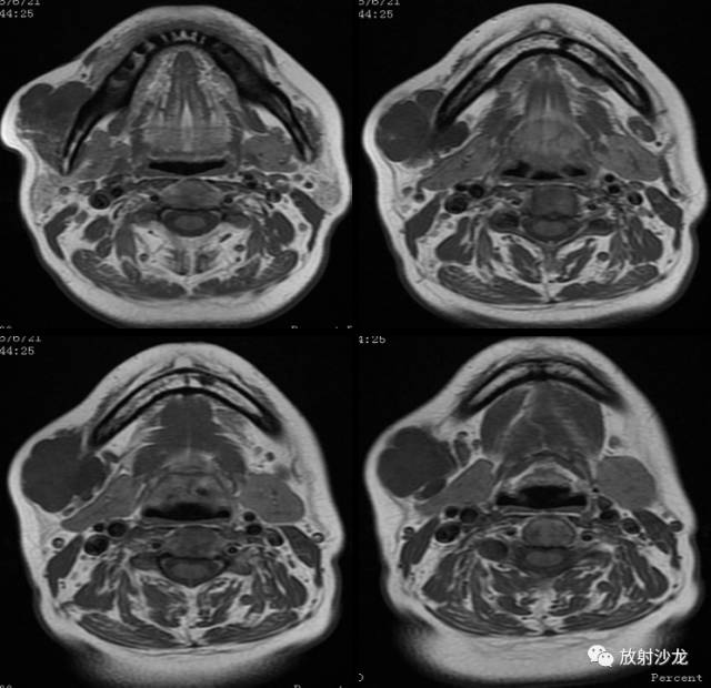 【病例】颊部淋巴管瘤1例MR影像表现