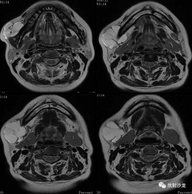 【病例】颊部淋巴管瘤1例MR影像表现