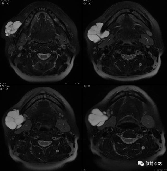 【病例】颊部淋巴管瘤1例MR影像表现
