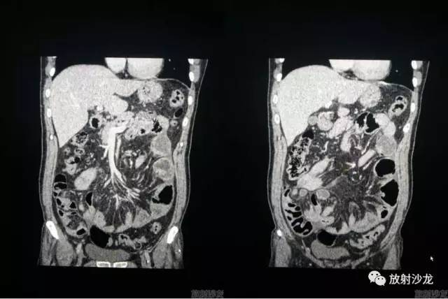 【病例】腹茧症1例CT影像表现