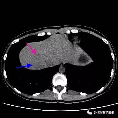 手把手教你会读片——肝腺瘤 手把手教你会读片——肝腺瘤