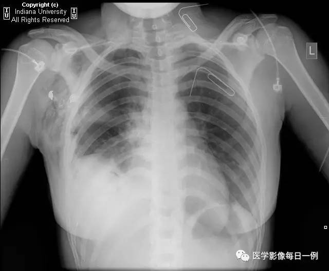 【病例】肾盏憩室1例CT