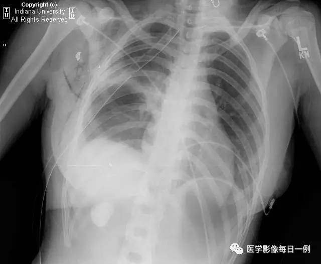 【病例】肾盏憩室1例CT