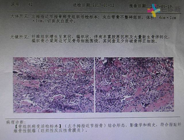 【病例】指趾纤维骨性假瘤1例X线