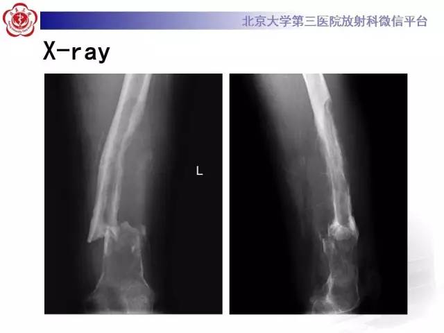 【病例】血友病性假肿瘤1例X线CT影像诊断与鉴别
