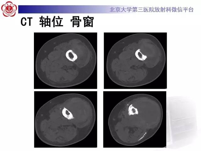 【病例】血友病性假肿瘤1例X线CT影像诊断与鉴别