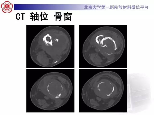 【病例】血友病性假肿瘤1例X线CT影像诊断与鉴别
