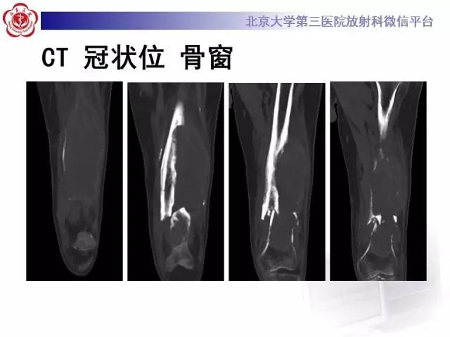 【病例】血友病性假肿瘤1例X线CT影像诊断与鉴别