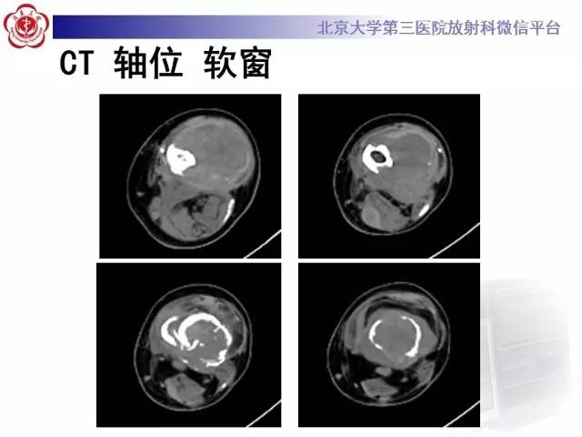 【病例】血友病性假肿瘤1例X线CT影像诊断与鉴别