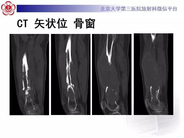 【病例】血友病性假肿瘤1例X线CT影像诊断与鉴别