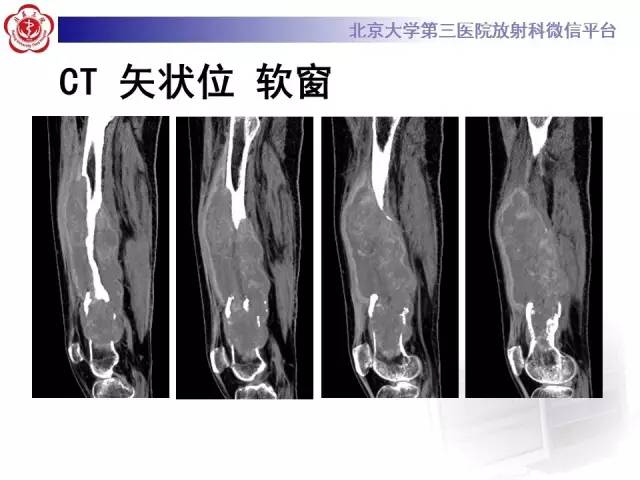 【病例】血友病性假肿瘤1例X线CT影像诊断与鉴别