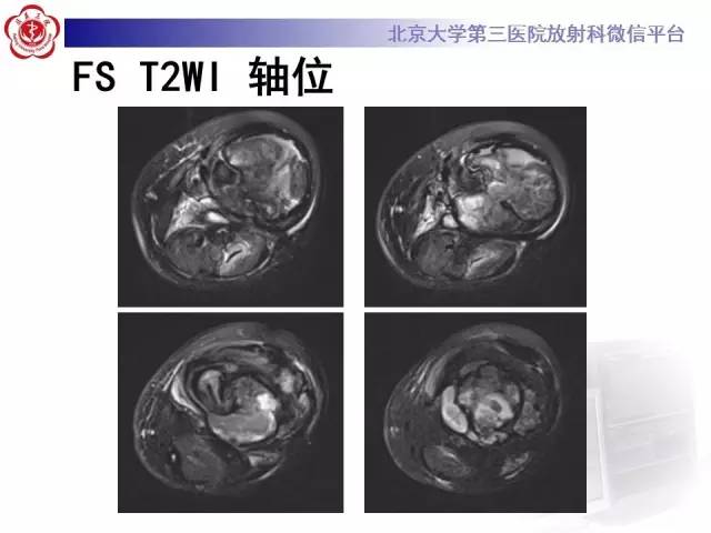 【病例】血友病性假肿瘤1例X线CT影像诊断与鉴别