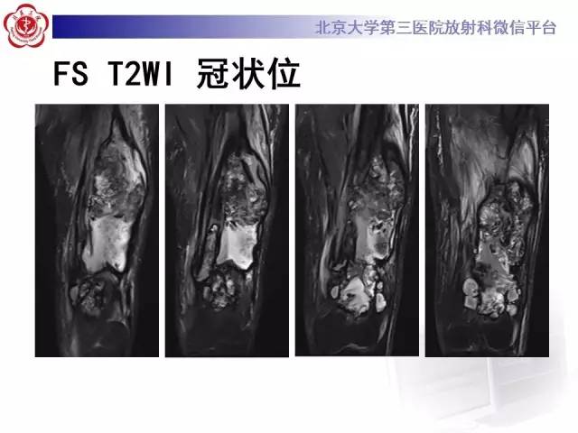 【病例】血友病性假肿瘤1例X线CT影像诊断与鉴别