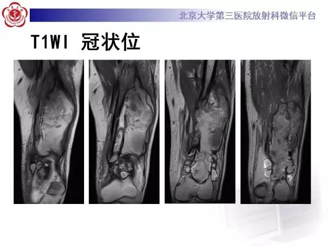 【病例】血友病性假肿瘤1例X线CT影像诊断与鉴别