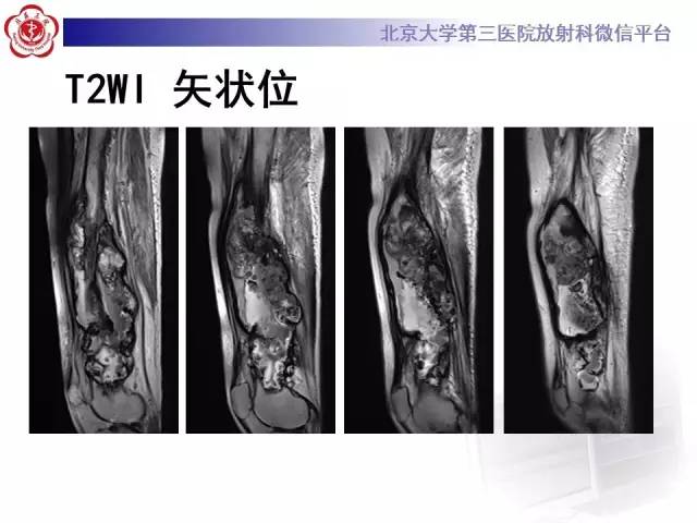【病例】血友病性假肿瘤1例X线CT影像诊断与鉴别