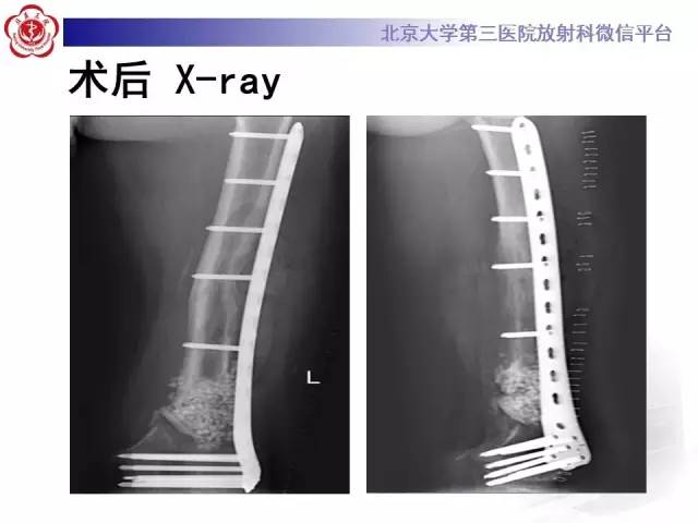 【病例】血友病性假肿瘤1例X线CT影像诊断与鉴别