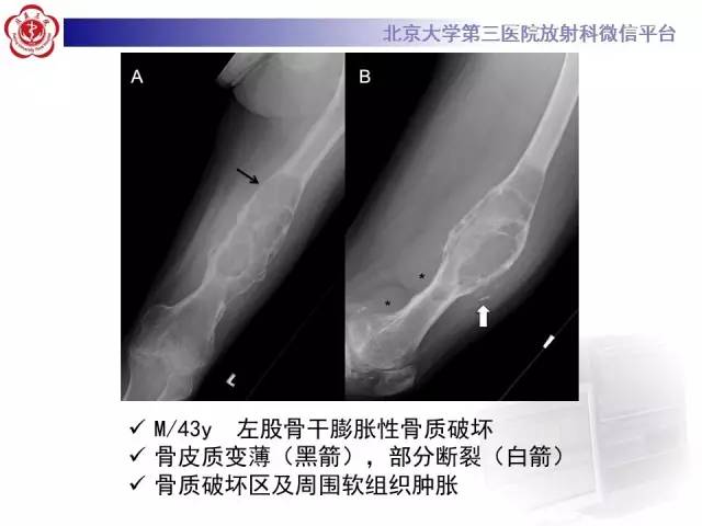 【病例】血友病性假肿瘤1例X线CT影像诊断与鉴别