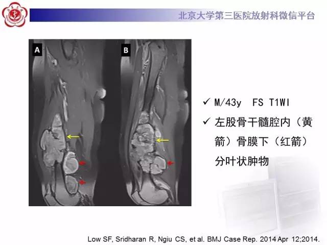 【病例】血友病性假肿瘤1例X线CT影像诊断与鉴别