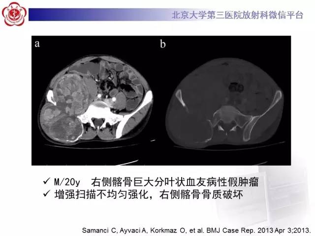 【病例】血友病性假肿瘤1例X线CT影像诊断与鉴别