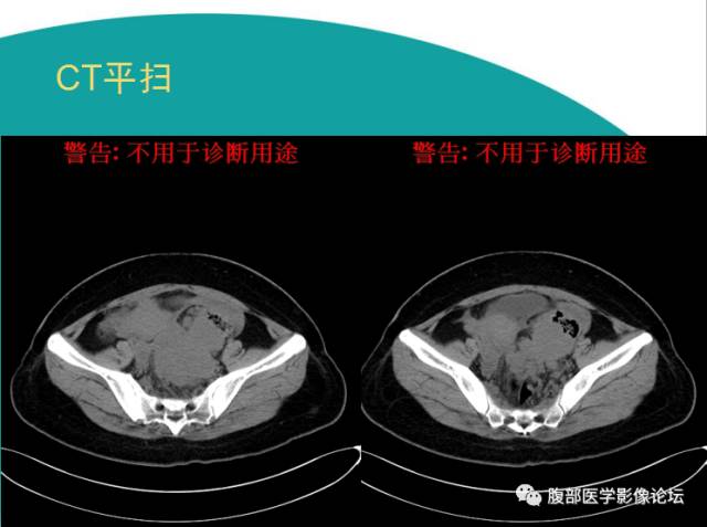 【病例】直肠副神经节细胞瘤1例CT及MR 【病例】直肠副神经节细胞瘤1例CT及MR